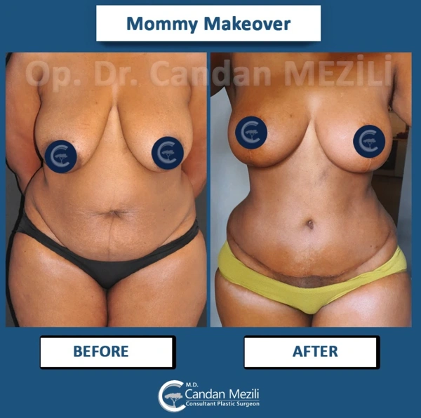Candan Mezili Mama-Makeover results in Turkey – case 593