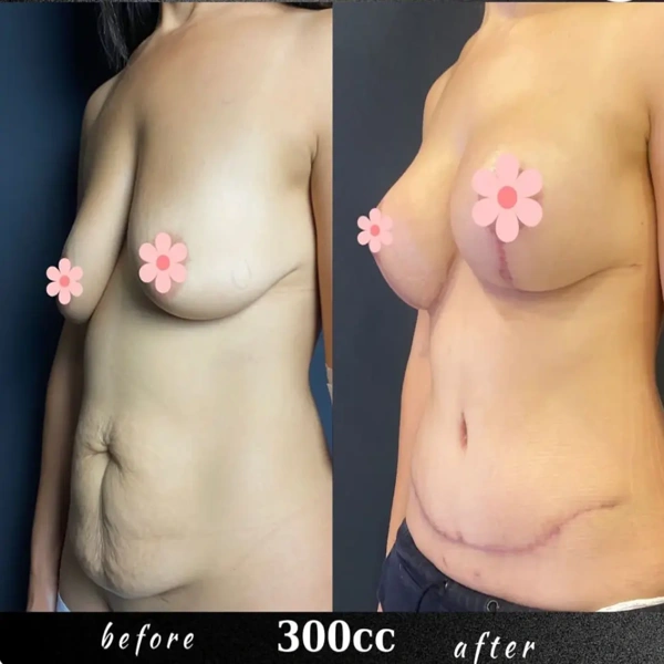 Duran Cekic Mama-Makeover results in Turkey – case 644