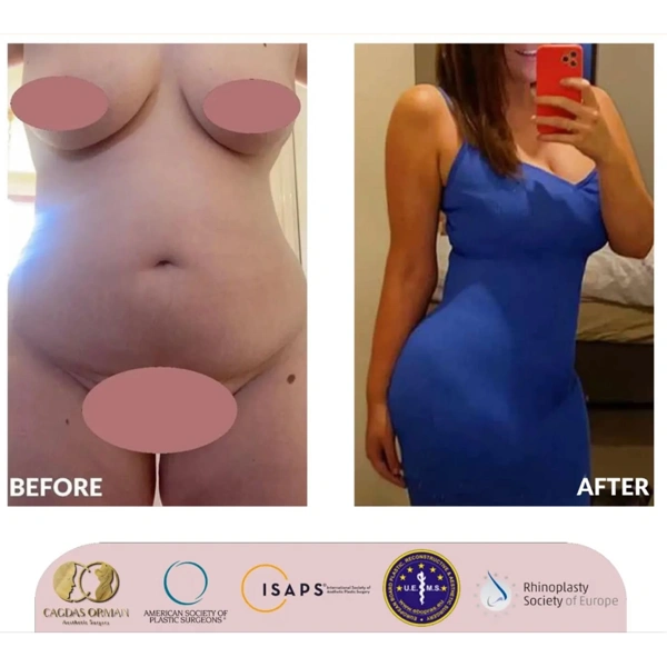 Cagdas Orman Mama-Makeover results in Turkey – case 692