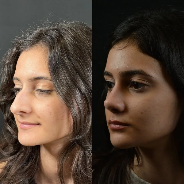 Alev Camcioglu Nasenkorrektur (Nasen OP) results in Turkey – case 24
