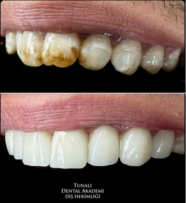 Sevket Tunali Zahnveneers  results in Turkey – case 261