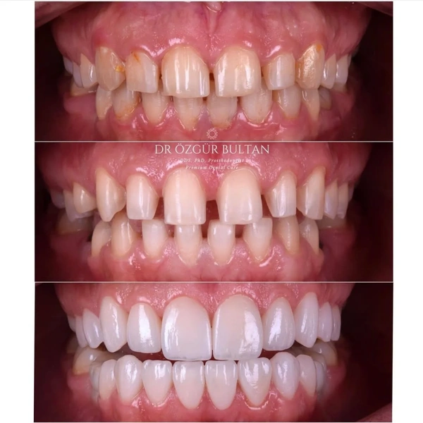 Ozgur  Bultan Zahnveneers  results in Turkey – case 331