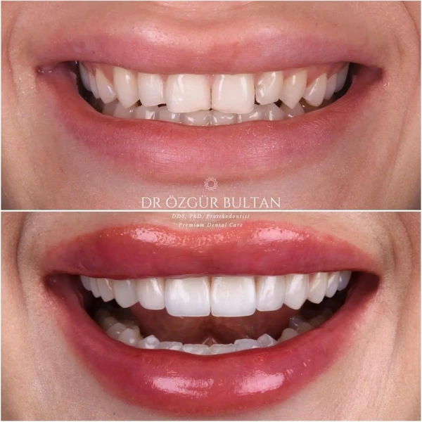 Ozgur  Bultan Zahnveneers  results in Turkey – case 336