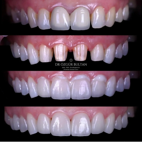 Ozgur  Bultan Zahnveneers  results in Turkey – case 338