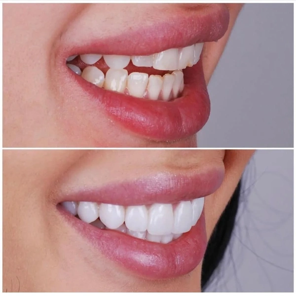 Zahnveneers  Vorher-nachher-Galerie – Weiblich Fall 406