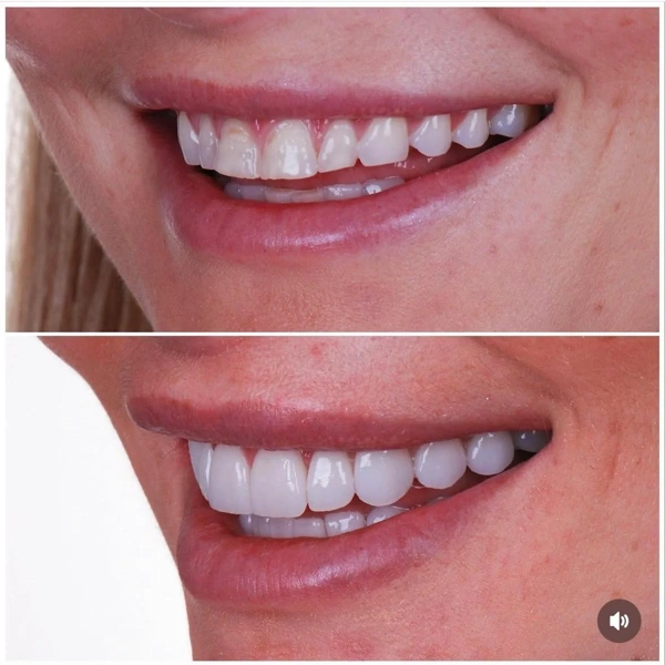 Kubel  Ozkut Zahnveneers  results in Turkey – case 411