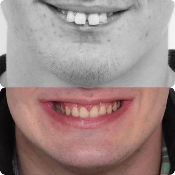 Merve  Ozkan Akagunduz Zahnveneers  results in Turkey – case 413