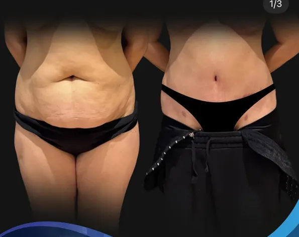 Αποτελέσματα πριν και μετά του Mommy makeover στην Τουρκία – περίπτωση 568