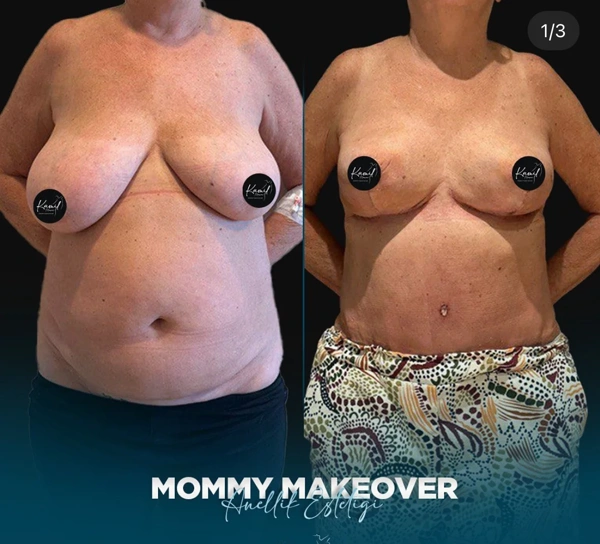 Kamil Manav Mommy makeover results in Turkey – case 569