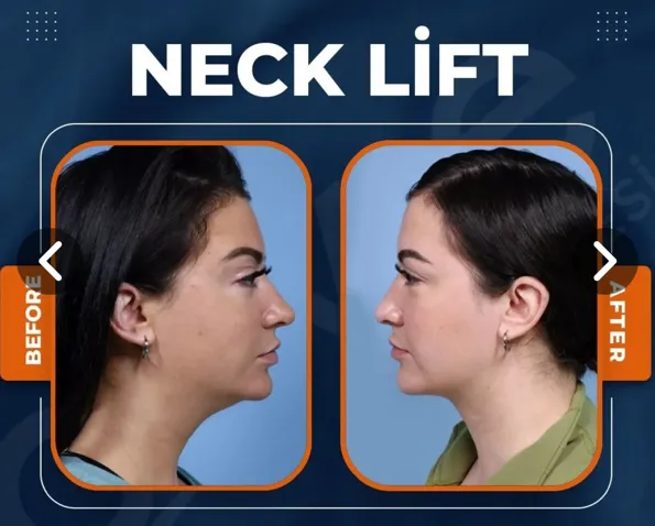 Αποτελέσματα πριν και μετά του Αντιγήρανση προσώπου στην Τουρκία – περίπτωση 92