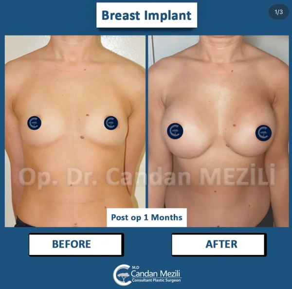 Candan Mezili Αυξητική Στήθους results in Turkey – case 584