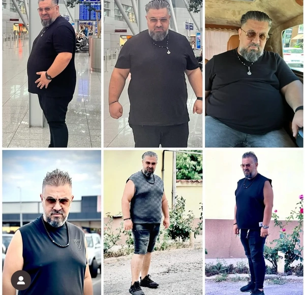 Umut Rıza Gunduz Γαστρεκτομή με μανίκι results in Turkey – case 504
