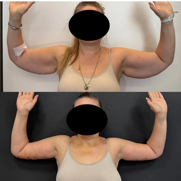 Cem Berkay  Sinaci Full Body Lift results in Turkey – case 314