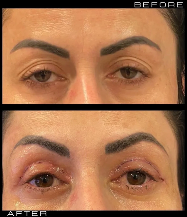Duran Cekic Blepharoplasty results in Turkey – case 642