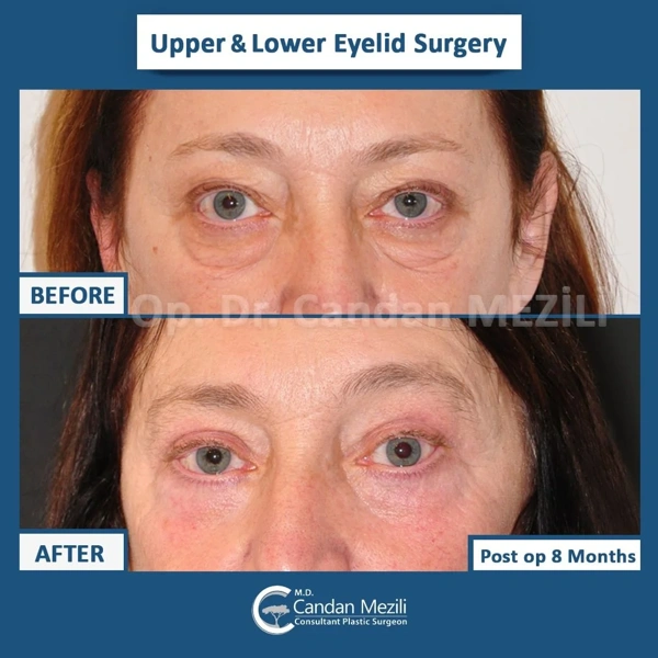 Blepharoplasty abroad package before and after results – case 464