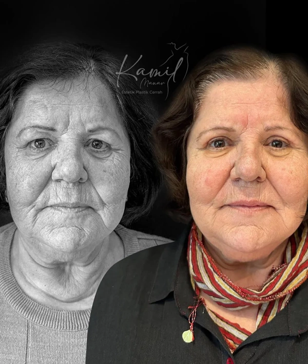 Blepharoplasty abroad package before and after results – case 554