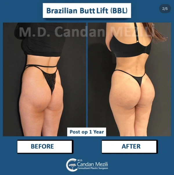 Candan Mezili BBL (Brazilian Butt Lift) results in Turkey – case 579