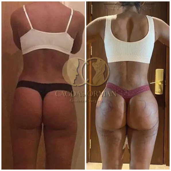 BBL (Brazilian Butt Lift) before and after results in Turkey – case 163