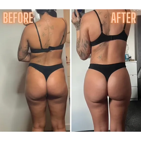 BBL (Brazilian Butt Lift) before and after results in Turkey – case 669