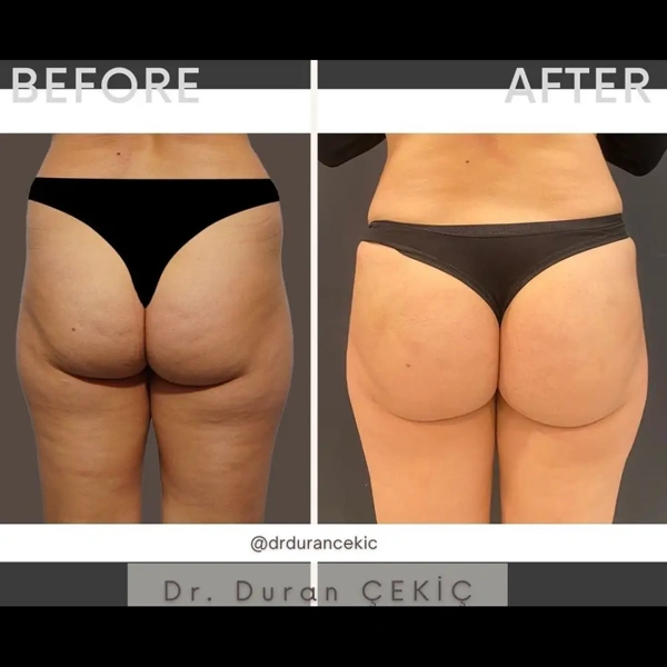 Duran Cekic BBL (Brazilian Butt Lift) results in Turkey – case 635