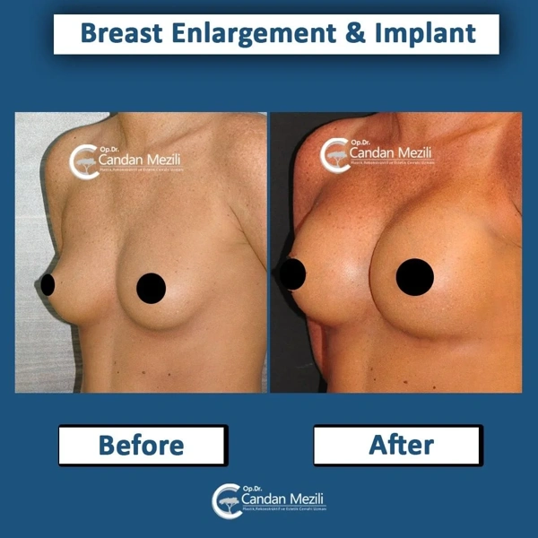 Candan Mezili Breast Augmentation results in Turkey – case 483