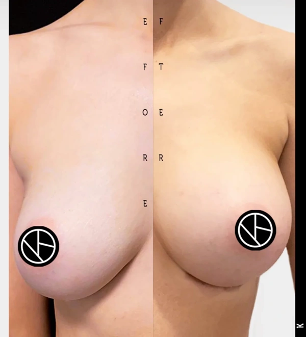 Bora  Ok Breast Lift results in Turkey – case 150
