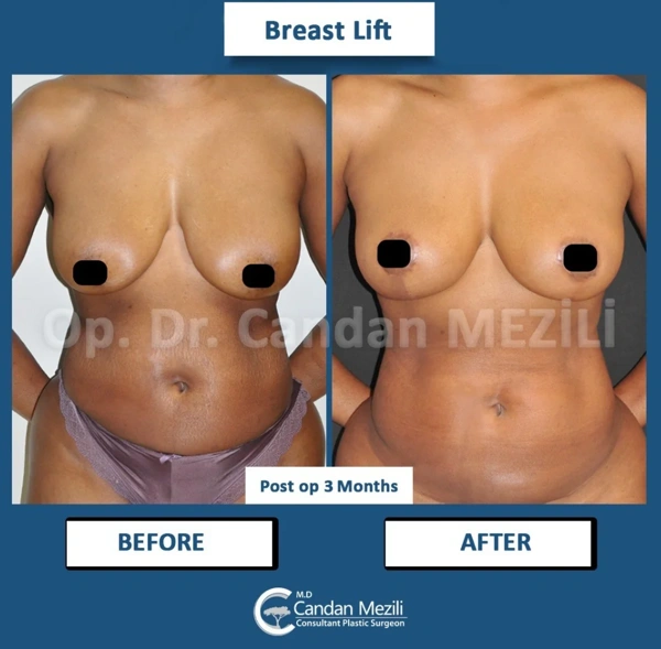 Breast Lift abroad package before and after results – case 587