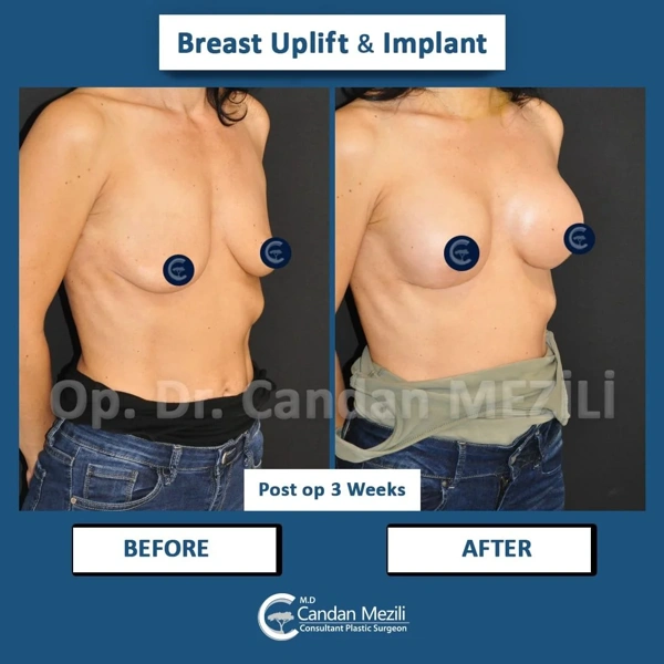Candan Mezili Breast Lift results in Turkey – case 472