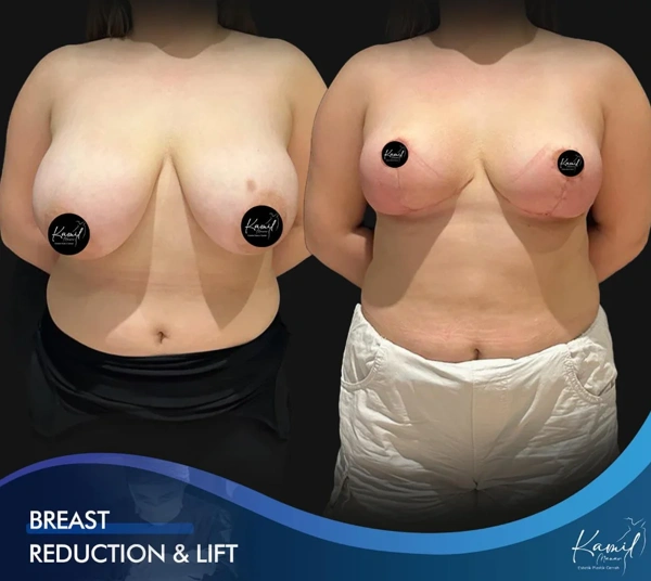 Breast Reduction abroad package before and after results – case 652