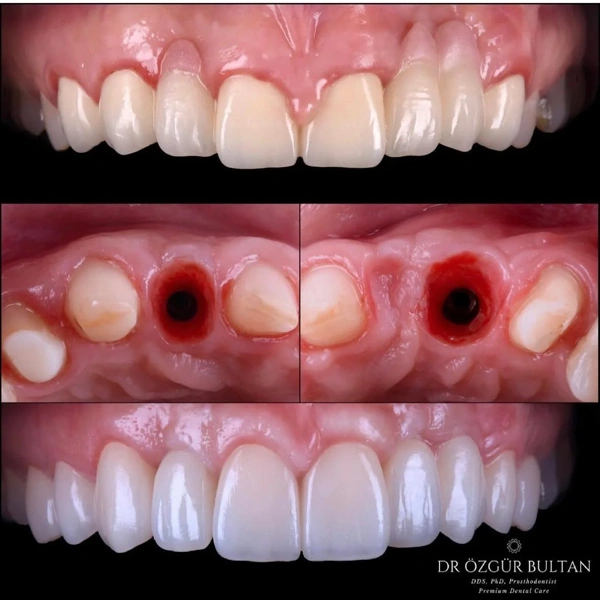 Ozgur  Bultan Dental Implant results in Turkey – case 327
