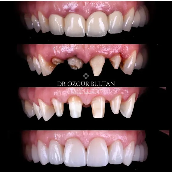 Dental Veneers before and after results in Turkey – case 334