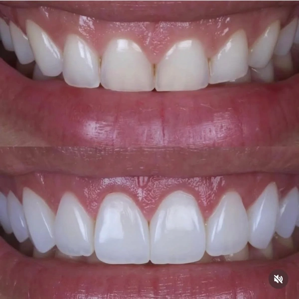 Fikret  Altan Dental Veneers results in Turkey – case 343