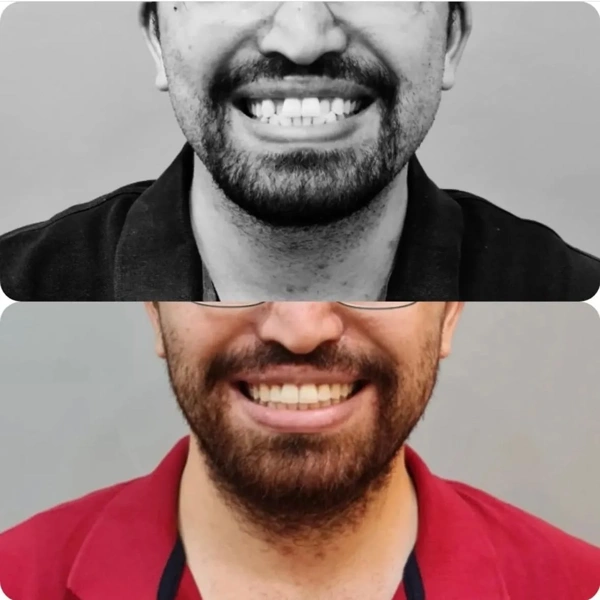 Merve  Ozkan Akagunduz Dental Veneers results in Turkey – case 417