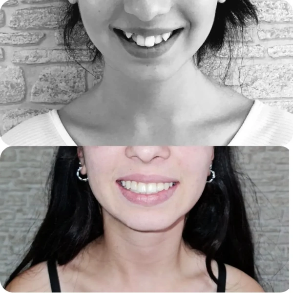 Merve  Ozkan Akagunduz Dental Veneers results in Turkey – case 419