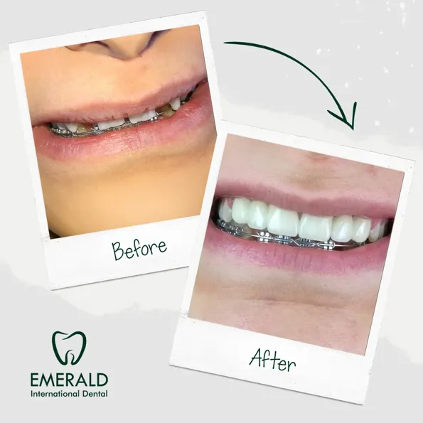 Dental Implant before and after results in Turkey – case 427