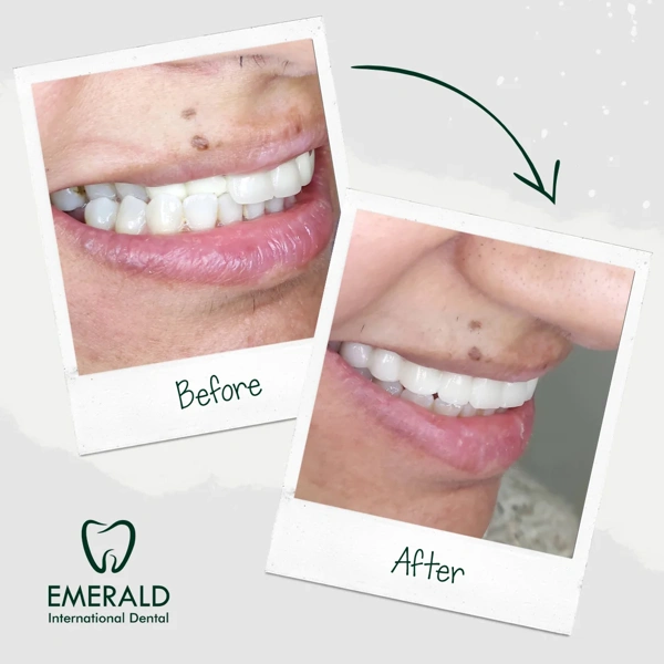 Dental Veneers abroad package before and after results – case 430