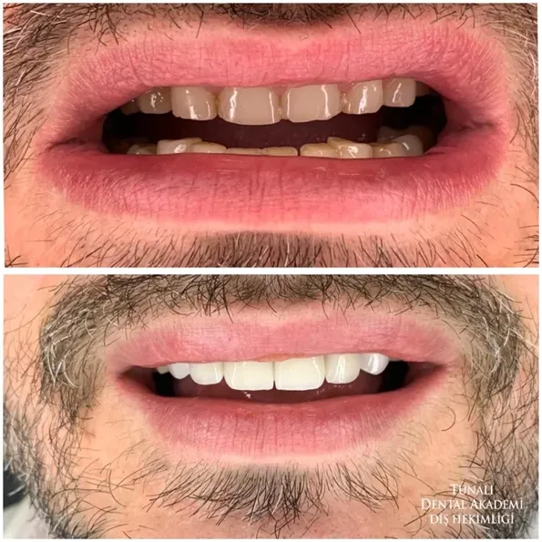 Dental Veneers before and after results in Turkey – case 257