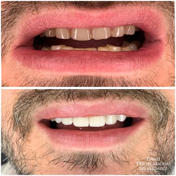 Dental Veneers before and after gallery – Male case 257