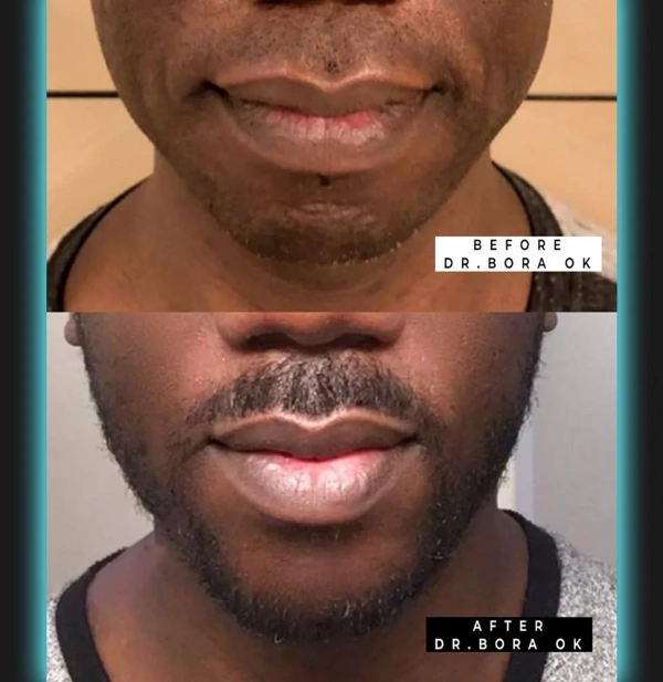 Bora  Ok Facelift results in Turkey – case 154