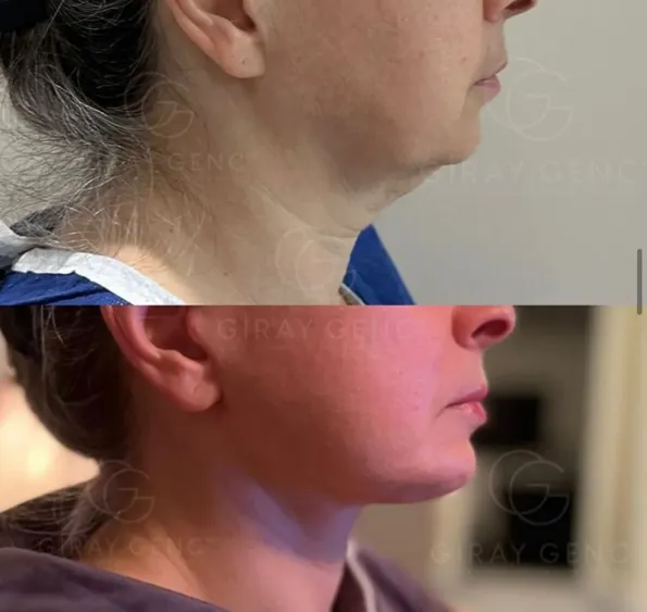 Facelift before and after results in Turkey – case 195