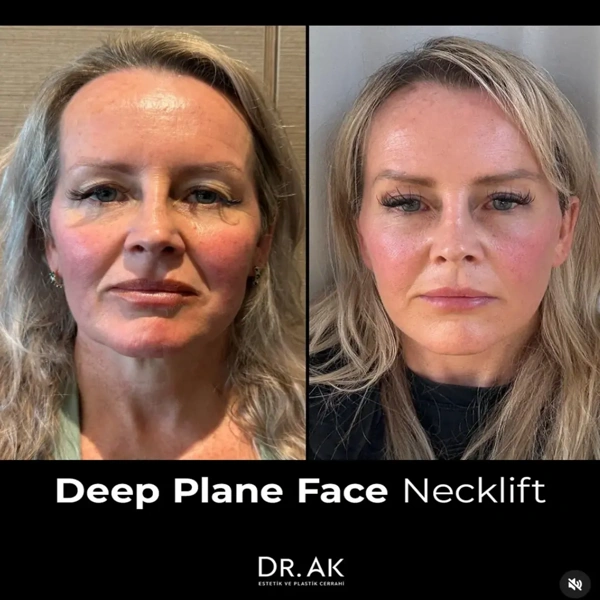 Erman Ak Facelift results in Turkey – case 609