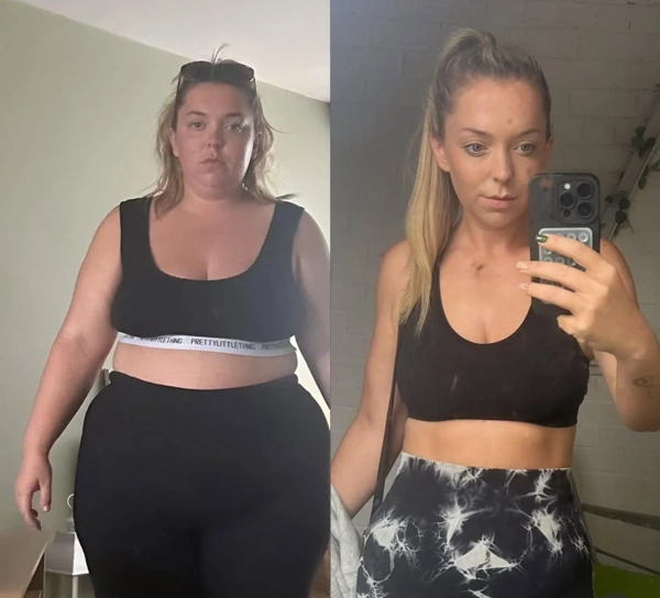 Gastric Balloon abroad package before and after results – case 507