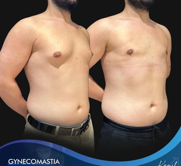 Gynecomastia Surgery abroad package before and after results – case 552