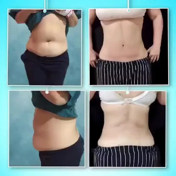 Tayfun Turkaslan Liposuction results in Turkey – case 47