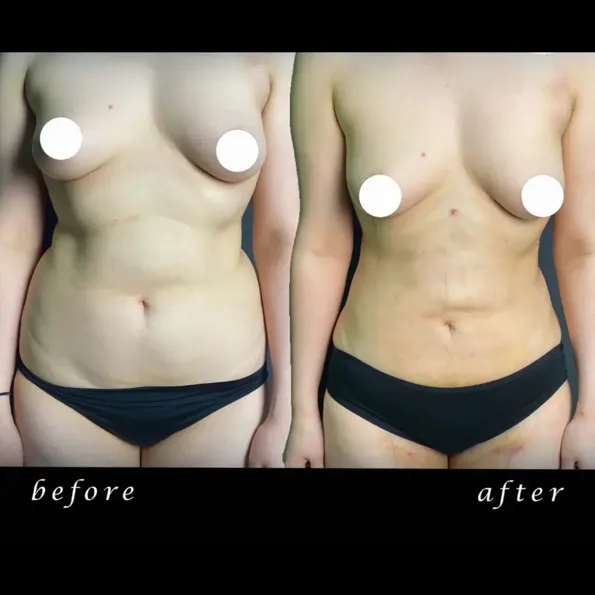 Liposuction before and after results in Turkey – case 639
