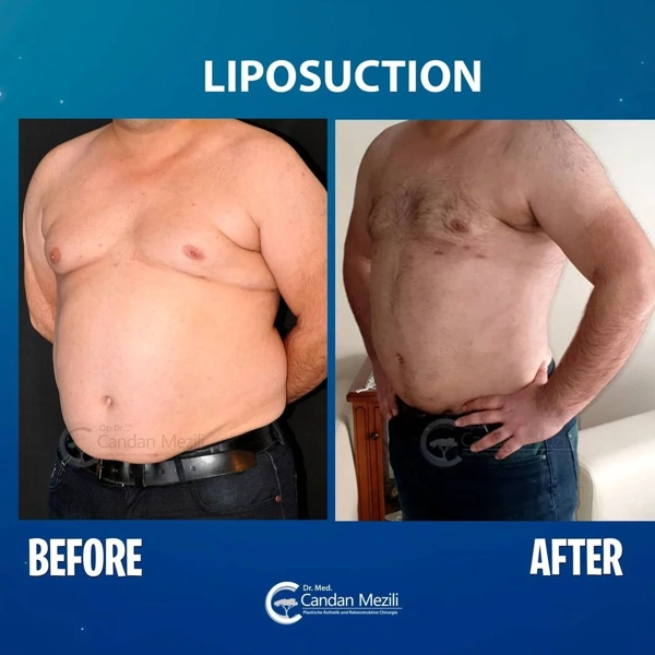 Candan Mezili Liposuction results in Turkey – case 459