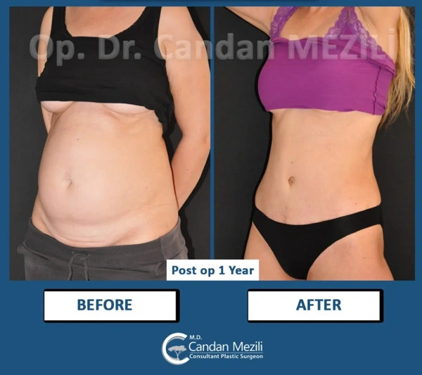 Mommy Makeover abroad package before and after results – case 595