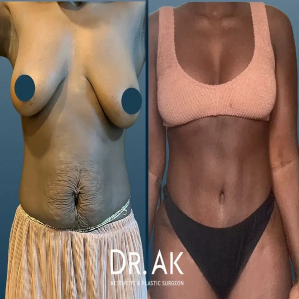 Erman Ak Mommy Makeover results in Turkey – case 615