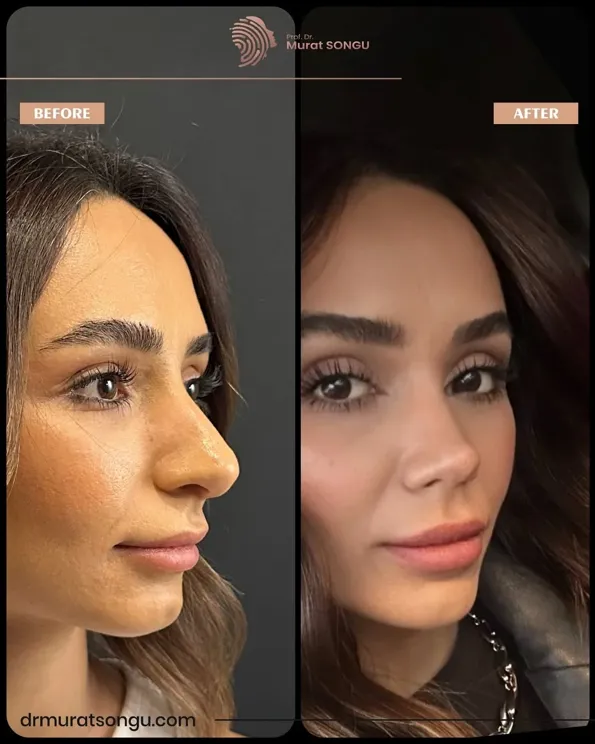 Rhinoplasty (Nose job) before and after results in Turkey – case 18
