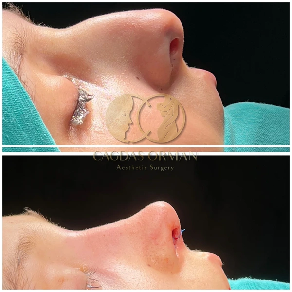 Rhinoplasty (Nose job) before and after gallery – Female case 175